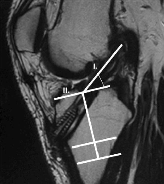 This diagnostic image is a sagittal MRI of a human knee post-anterior cruciate ligament (ACL) reconstruction, demonstrating the methodology for measuring the graft inclination angle. The image features the distal femur, proximal tibia, and an ACL graft passing through a tibial bone tunnel. To calculate the inclination angle, two primary reference lines are superimposed: Line I is drawn tangential to the anterior border of the ACL graft, and Line II is drawn tangential to the anterior aspect of the intercondylar eminence, perpendicular to the long axis of the tibia. The intersection of these lines defines the sagittal obliquity of the graft. Additional white annotations indicate the tibial long axis and segmental markers along the tibia for orientation. This visualization is used in orthopedic radiology to assess the anatomic positioning of the reconstructed ligament, which is critical for evaluating surgical outcomes, joint stability, and the risk of graft impingement or failure. The clinical significance lies in ensuring the graft's orientation mimics the native ACL's biomechanical properties.