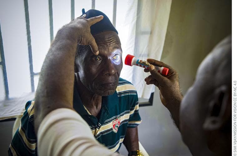 This clinical photograph captures a handheld torch examination (penlight test) performed on an elderly male patient in a primary care setting. An examiner is shown using a small flashlight to provide focal illumination to the patient's left eye. The technique illustrates the screening for leukocoria or dense lenticular opacities, as evidenced by the bright white/yellowish reflex visible within the pupillary area, which is highly suggestive of a mature cataract. A second individual is assisting by stabilizing the patient's forehead and elevating the upper eyelid to ensure clear visualization of the ocular surface and pupillary response. This image serves as an educational example of basic ophthalmic triage and physical examination techniques used by primary health workers to identify common causes of preventable blindness, such as cataracts, in resource-limited environments. The focus is on the diagnostic approach of using focal light to detect gross anatomical abnormalities of the anterior segment.