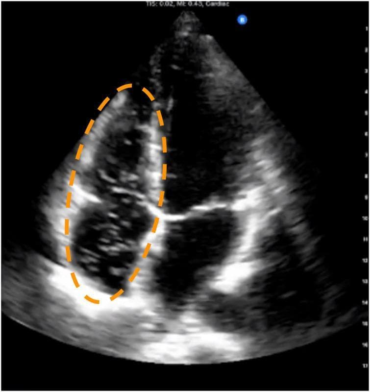 This diagnostic image is a B-mode apical four-chamber trans-thoracic echocardiogram (TTE) demonstrating the presence of venous gas emboli (VGE). The visual focuses on the right-sided heart chambers (right atrium and right ventricle), highlighted by an orange dashed ellipse. Within these chambers, numerous discrete, punctate, hyper-echoic signals are visible circulating against the dark, anechoic background of the blood pool. These bright spots represent intravascular gas bubbles, often monitored using the Eftedal-Brubakk (EB) scale in decompression sickness research and diving medicine. The contrast between the hyper-echoic VGE and the relatively echo-free blood pool allows for the quantification of bubble load. The anatomical structures, including the interventricular and interatrial septa and valve leaflets, provide the structural context for identifying the venous side of the heart. This image is used educationally to demonstrate the ultrasound appearance of circulating gas emboli and the application of cardiac imaging in physiological monitoring.
