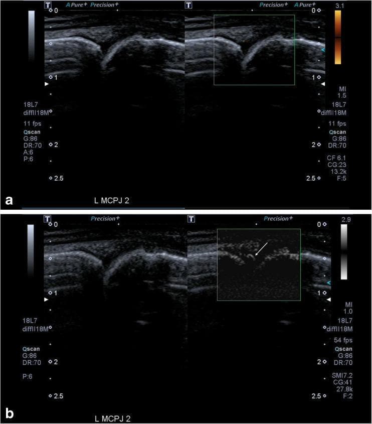 This diagnostic image set displays a side-by-side comparison of different ultrasound modalities used to assess inflammation in the second left metacarpophalangeal joint (MCPJ) of a patient with rheumatoid arthritis. Panel (a) features a dual-view ultrasound: the left side shows a grey-scale (B-mode) image of a relatively normal-appearing joint space, while the right side employs Power Doppler Ultrasound (PDUS), which fails to detect any significant vascular flow within the joint. Panel (b) provides a corresponding view using Superb Microvascular Imaging (SMI). In contrast to the PDUS, the SMI mode (indicated by the arrow) reveals clear, fine neovascularity within the joint, signifying active synovitis. Technical parameters such as mechanical index (MI), frequency (18L7), frame rate (54 fps in SMI vs 11 fps in PDUS), and gain settings are visible in the margins. This comparison highlights the superior sensitivity and spatial resolution of SMI over traditional PDUS in detecting low-velocity microvascular flow associated with early or low-grade joint inflammation in musculoskeletal imaging.
