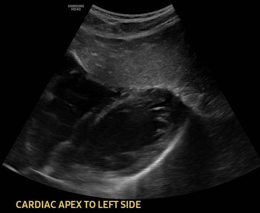 This diagnostic image is a 2D transthoracic ultrasound showing the cardiac apex in a levocardia position. The grayscale sonogram displays the heart as a predominantly hypoechoic (fluid-filled) structure with well-defined echogenic borders. The cardiac apex is oriented toward the lower-left portion of the frame. Surrounding the heart are tissues of varying intermediate echogenicity, representing pulmonary or mediastinal structures. A distinct, bright hyperechoic line visible at the inferior margin likely represents the pleura or diaphragmatic interface. The image is used in clinical education to confirm cardiac orientation (levocardia) and to assess gross structural morphology and chamber boundaries. No obvious focal lesions or abnormal fluid collections, such as pericardial effusion, are visible in this specific plane. This type of imaging is essential in primary care and cardiology for identifying situs abnormalities when correlated with abdominal organ positioning.