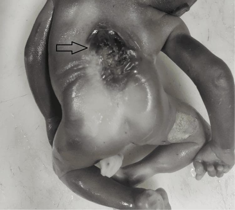 This clinical photograph shows a posterior view of a human fetus presenting with an open neural tube defect (NTD), specifically spina bifida aperta (myelomeningocele). The primary abnormality is located in the mid-to-lower thoracic spine, indicated by a black arrow. The defect appears as a large, midline ulcerated lesion where the skin and underlying vertebral arches have failed to fuse, exposing the neural placode and underlying meningeal tissues. The lesion shows evidence of hemorrhage and irregular borders. Surrounding the spinal defect, the skin appears thinned and tense. Additionally, the lower extremities and overall body structure are visible; there is evidence of skin maceration or epidermal desquamation on the right thigh, which may be secondary to intrauterine positioning or underlying pathology. This image illustrates a severe congenital central nervous system malformation, serving as a primary example of spinal dysraphism for medical education in embryology, neonatology, and fetal pathology.