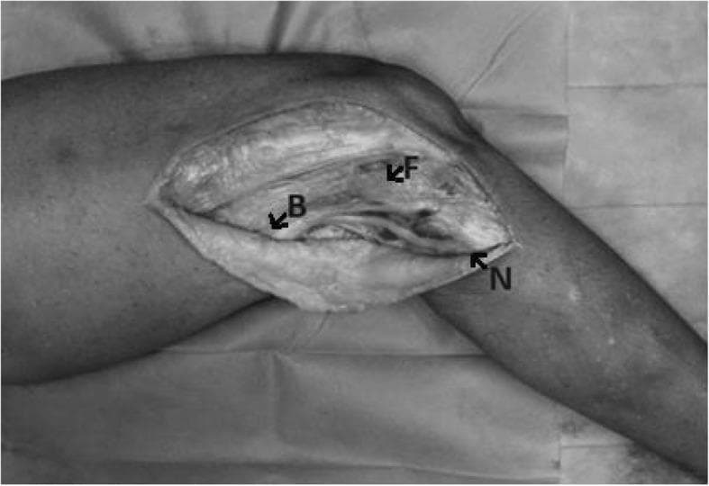 A clinical photograph of a cadaveric dissection of the lateral aspect of the human knee, illustrating key anatomical landmarks for identifying the common peroneal nerve (CPN). The image shows a longitudinal incision reflecting the skin and subcutaneous tissue to expose the posterolateral corner (PLC). Three specific points are labeled: Point 'F' indicates the bony prominence of the fibular head; Point 'B' marks the location where the common peroneal nerve crosses the posterior border of the biceps femoris muscle; and Point 'N' denotes the distal point where the CPN penetrates the fascia at the level of the fibular neck. The spatial relationship between these three points forms a 'FBN triangle,' an anatomical construct used to quantify nerve displacement and tension during knee flexion and extension. This image serves as a surgical anatomy guide for identifying and protecting the CPN during orthopedic procedures such as lateral collateral ligament reconstruction or proximal fibular osteotomy.