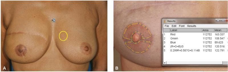 This clinical photograph and educational diagram illustrate a standardized method for quantitative color analysis of the nipple-areola complex (NAC) following reconstructive surgery. Image A presents a frontal view of a patient post-mastectomy with a contralateral natural NAC; a yellow circle identifies the region of interest (ROI) for baseline skin tone measurement on normal breast skin. Image B provides a close-up of a reconstructed and tattooed NAC. The areolar region is circumscribed by a yellow polygonal selection tool in ImageJ software, excluding the central nipple and surgical scars to ensure measurement accuracy. An overlaying 'Results' window displays calculated Red, Green, and Blue (RGB) mean values (R: 163.3, G: 108.5, B: 89.6) and total pixel area. This technique is used in plastic and reconstructive surgery to objectively monitor pigment fading, assess symmetry between natural and tattooed NACs, and evaluate the long-term aesthetic outcomes of various tattooing pigments and donor skin types (e.g., abdominal, dorsal, or breast skin).