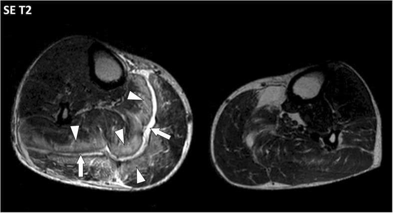 This diagnostic image is an axial Spin Echo (SE) T2-weighted MRI of the lower legs, demonstrating findings consistent with necrotizing fasciitis in the right leg (left side of image). The primary pathological hallmark is significant thickening and hyperintensity of the deep intermuscular fascia, specifically visualized between the gastrocnemius and soleus muscles. This bright, fluid-like signal along the fascial planes (indicated by arrows) suggests inflammatory fluid accumulation and necrosis. Additionally, there is extensive high-signal infiltration within the connective tissue and endomysium of the adjacent muscles (indicated by arrowheads), representing reactive edema and inflammatory spread. The contralateral leg serves as a healthy anatomical reference, highlighting the marked asymmetry, fascial distension, and soft tissue swelling present in the affected limb. This imaging modality is critical for assessing the depth of soft tissue infections and identifying the involvement of deep fascial layers and muscular compartments, which are key indicators for surgical intervention in necrotizing soft tissue infections.