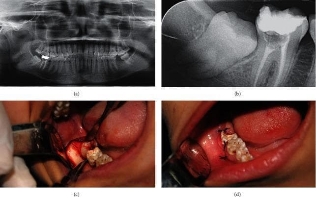This composite figure illustrates the clinical and radiographic progression of a surgical extraction of an impacted mandibular right third molar. Image (a) is a panoramic radiograph providing a global view of the dental arches, showing the molar's orientation within the mandible. Image (b) is a localized periapical radiograph offering high-detail visualization of the impacted crown, root morphology, and its relationship to the second molar's distal root. Image (c) is an intraoperative clinical photograph demonstrating the surgical field following a pyramidal incision and mucoperiosteal flap elevation. It shows the exposed bone and the partially visible impacted crown with surgical instruments in situ, highlighting the buccal and distal guttering technique. Image (d) is a postoperative clinical photograph showing the extraction site closed with black silk simple interrupted sutures. The series serves as an educational resource for oral and maxillofacial surgery, demonstrating the transition from diagnostic imaging to surgical access and final primary closure in dental impaction management.