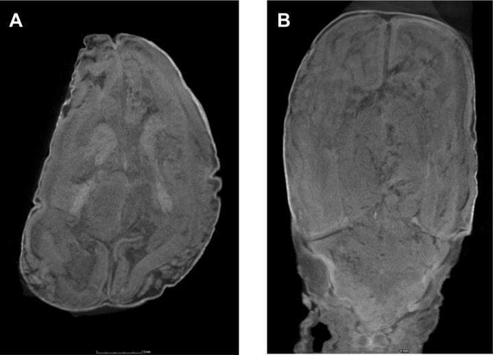 High-resolution micro-focus computed tomography (micro-CT) scans of a 13-week-gestation fetal brain, highlighting the challenges of postmortem imaging in cases of maceration and autolysis. Figure A displays an axial section at the level of the basal ganglia, while Figure B shows a coronal section through the posterior fossa and occipital lobes. Both images demonstrate significant intracranial tissue degradation. Key pathological features include a loss of the normal gray-white matter differentiation and a lack of distinct cerebral sulcation, which appears disrupted or poorly defined. The imaging resolution (35 μm) allows for detailed assessment of the internal architecture; however, the parenchymal changes shown are characteristic of postmortem autolysis, which can render fetal neuroimaging nondiagnostic for structural malformations. This content is relevant for pediatric radiology, fetal pathology, and researchers evaluating noninvasive autopsy techniques using micro-CT.