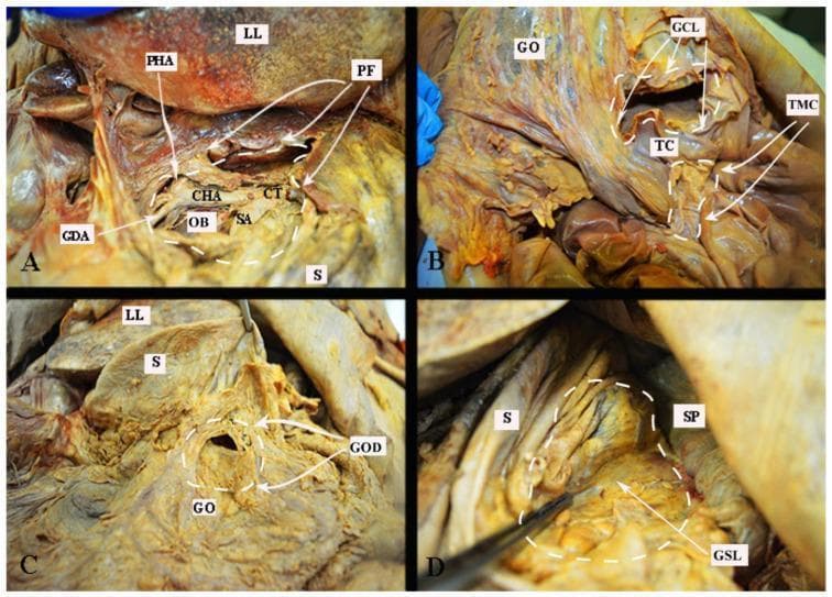 This medical anatomical composite consists of four clinical photographs of an embalmed cadaver dissection illustrating various surgical approaches to the omental bursa (lesser sac). Panel A shows the supragastric approach via the pars flaccida (PF) of the lesser omentum, revealing the celiac trunk (CT) and its branches: the common hepatic (CHA), splenic (SA), and proper hepatic (PHA) arteries, with the gastroduodenal artery (GDA) visible near the omental bursa (OB) and stomach (S). Panel B demonstrates the trans-mesocolic (TMC) approach and dissection of the gastrocolic ligament (GCL), highlighting the anatomical relationship between the transverse colon (TC) and greater omentum (GO). Panel C illustrates direct dissection through the greater omentum (GOD) inferior to the stomach's greater curvature. Panel D depicts the lateral approach via the gastrosplenic ligament (GSL), showing the spatial orientation of the spleen (SP) relative to the stomach. These panels serve as educational references for surgeons navigating the complex peritoneal attachments and vascular landmarks required for cytoreductive surgery in conditions such as advanced epithelial ovarian cancer.