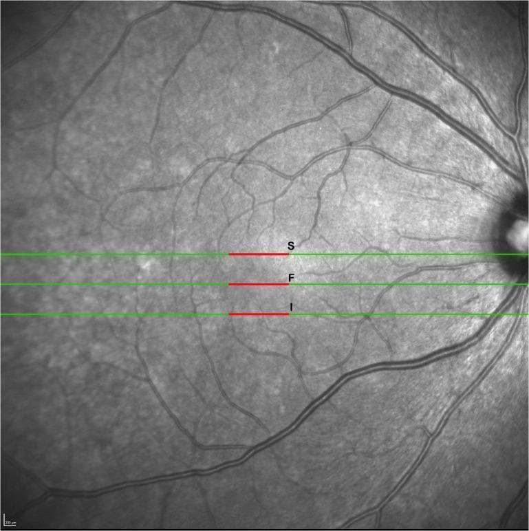 This diagnostic image is a high-resolution, grayscale scanning laser ophthalmoscopy (SLO) fundus image used as a reference for Optical Coherence Tomography (OCT) raster scanning. The image displays the posterior pole of the human retina, with the optic disc visible on the far right and the retinal vasculature radiating toward the macula. Three horizontal green lines indicate the orientation of specific B-scans across the macular region. Overlaid on these green lines are red segments (labeled S, F, and I) centered horizontally. The central line 'F' (Fovea) passes through the foveal center, while 'S' (Superior) and 'I' (Inferior) represent scans located 1,270 microns superior and inferior to the fovea, respectively. The 1,000-micron red segments signify the specific lateral zones where retinal layer thickness measurements (segmentation analysis) were performed. This visual is used in ophthalmology to demonstrate the methodology for mapping retinal morphology and quantifying regional thickness variations in clinical research.