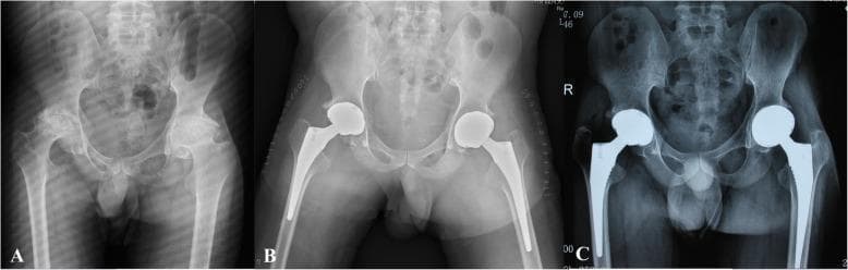 This composite diagnostic image features three anteroposterior (AP) pelvic X-rays (labeled A, B, and C) illustrating a case of haemophilic arthropathy and its surgical management with bilateral total hip arthroplasty (THA).
Panel A shows the preoperative state, characterized by severe bilateral degenerative changes in the hip joints. Visible features include significant joint space narrowing, subchondral sclerosis, and irregular femoral head morphology, typical of advanced haemophilic arthropathy.
Panel B displays the immediate postoperative appearance after bilateral THA. Radiopaque prosthetic components are visible on both sides, consisting of acetabular cups, femoral heads, and femoral stems securely positioned within the medullary canals.
Panel C is a one-year follow-up radiograph with a digitally enhanced overlay of the prosthetic hardware. The image demonstrates stable implant positioning without evidence of progressive radiolucent lines (> 2 mm), indicating successful osseointegration and maintenance of alignment. The series serves as an educational comparison between end-stage joint disease and successful surgical intervention in a patient with Haemophilia A.