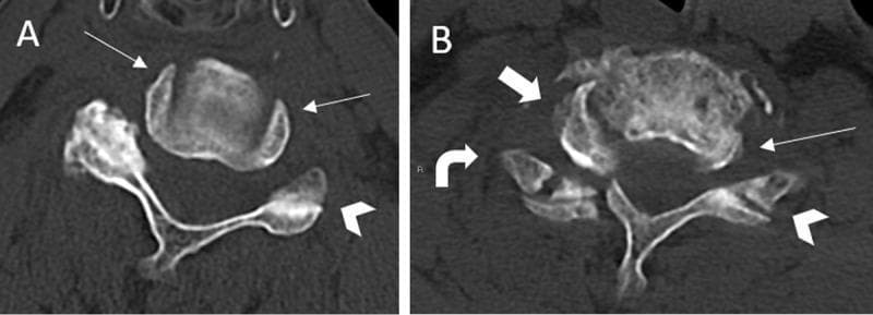 Diagnostic axial CT scan of the cervical spine comparing normal anatomy (Image A) with a unilateral cervical facet joint dislocation (UCFJD) (Image B). Image A demonstrates the normal concentric alignment of bilateral uncovertebral joints, where the uncinate processes frame the vertebral body symmetrically, creating the 'headphones sign'. Image B shows a traumatic right-sided dislocation in an 80-year-old male. Key radiological signs include the 'positive headphones sign,' where the vertebral body is shifted anteriorly and rotated towards the left, losing its symmetrical relationship with the right uncinate process (thick arrow). Furthermore, the left facet joint remains intact with a normal 'hamburger bun sign' appearance (chevron), while the right facet joint is disrupted and assumes a 'reverse hamburger bun sign' (curved arrow) due to the loss of joint apposition. This comparison illustrates critical diagnostic markers for identifying cervical spine instability and facet joint injuries on axial imaging.