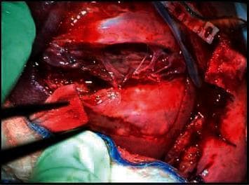 This clinical photograph captures an intraoperative view of a fetal surgical repair for a myelomeningocele (spina bifida). The image displays a large 5 x 5 cm neural tube defect located in the lumbosacral region, characterized by exposed neural placode and surrounding meningeal tissue. Associated with the defect is a visible kyphotic spinal deformity. Surgical instruments are seen manipulating the area where the repair is being performed. The procedure demonstrates the closure technique using a skin patch sewn over the open defect to protect the spinal cord and prevent further damage from amniotic fluid exposure. The surgical field includes medical drapes, sutures, and specialized instrumentation utilized in maternal-fetal surgery. This visual illustrates key concepts in pediatric neurosurgery and fetal intervention, specifically the management of congenital central nervous system malformations and the techniques required for anatomical closure of myelomeningocele.