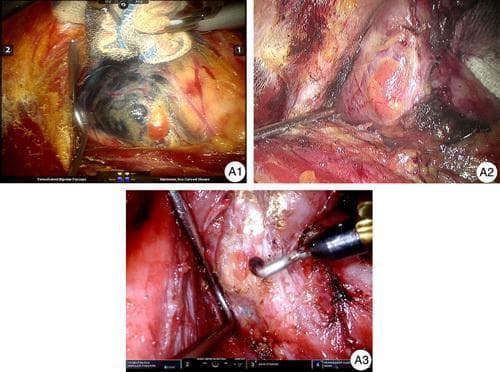 This set of intraoperative clinical photographs demonstrates the surgical anatomy and classification of parathyroid glands (PGs) during a thyroidectomy. The images are categorized into three types based on their anatomical relationship to the thyroid capsule. Type A1 shows a parathyroid gland located on the external surface of the thyroid gland, adhering to the outer layer. Type A2 illustrates a gland that is partially or entirely embedded within the thyroid tissue but remains external to the true thyroid capsule. Type A3 depicts an intracapsular parathyroid gland, which is entirely enclosed within the thyroid's true capsule. The photographs highlight the use of surgical instruments, such as fine dissectors and harmonic shears, to perform subcapsular meticulous dissection (SMCD). This technique aims to preserve the PGs in situ, along with their secondary and tertiary vascular supply, to prevent postoperative hypoparathyroidism. The visual contrast between the yellowish-brown or reddish hue of the parathyroid glands and the darker thyroid parenchyma is a key diagnostic feature for surgical identification.