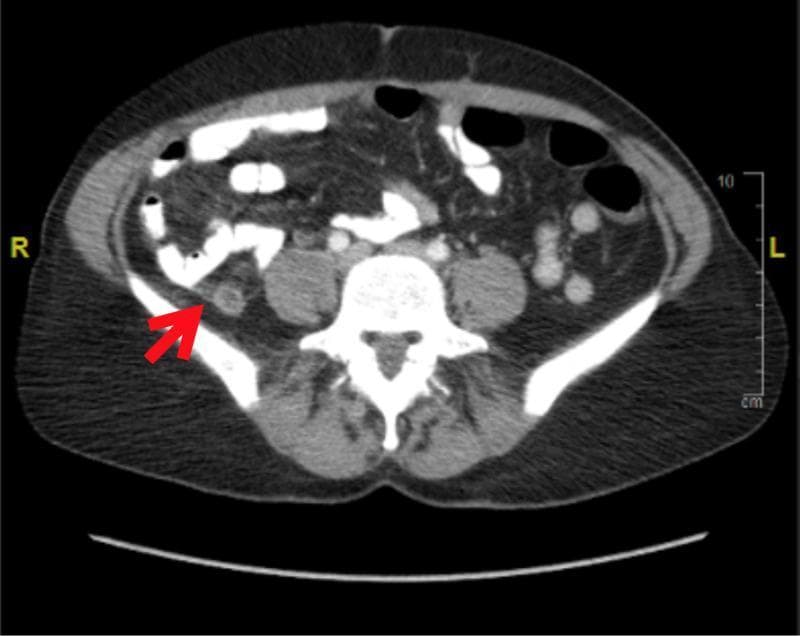 This diagnostic image is an axial computed tomography (CT) scan of the lower abdomen and pelvis, oriented in a cross-sectional view with the patient's right (R) and left (L) sides indicated. A red arrow in the right lower quadrant points to a dilated and thickened appendix, which measures approximately 10 mm in diameter. The visual hallmark of acute appendicitis is demonstrated by the presence of periappendiceal fat stranding—increased density and haziness in the surrounding mesenteric fat—suggesting localized inflammation. Anatomical landmarks include the vertebral body of the spine centrally, the psoas muscles bilaterally, and loops of bowel. The scan illustrates the classic radiological presentation of uncomplicated acute appendicitis, used for diagnostic confirmation in clinical emergency medicine. The imaging provides evidence of inflammation without visual signs of perforation or abscess formation at this level.