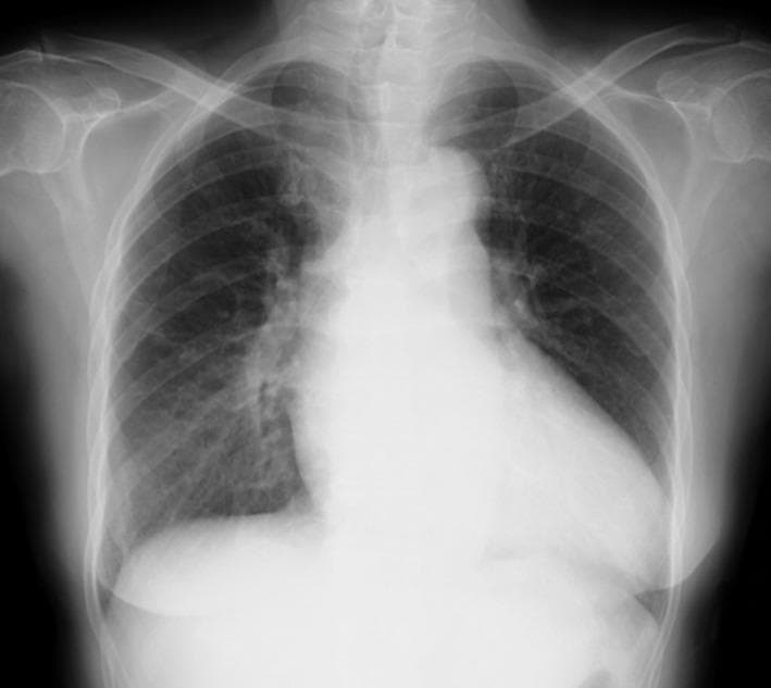 A posterior-anterior (PA) chest X-ray demonstrating a combination of thoracic findings. The image reveals prominent bilateral hilar lymphadenopathy (BHL), characterized by well-defined, bulky opacities in both hilar regions, consistent with Stage II sarcoidosis. Additionally, there is evidence of pulmonary edema, visualized as increased perihilar haziness and interstitial markings radiating from the central lung zones, which obscures the sharp margins of the pulmonary vasculature. The cardiac silhouette appears slightly enlarged, and there is a mild reduction in the clarity of the costophrenic angles. The musculoskeletal structures and overlying soft tissues are unremarkable. This radiographic presentation is significant for assessing systemic conditions such as cardiac sarcoidosis, where lymphadenopathy and acute congestive heart failure findings may coexist.
