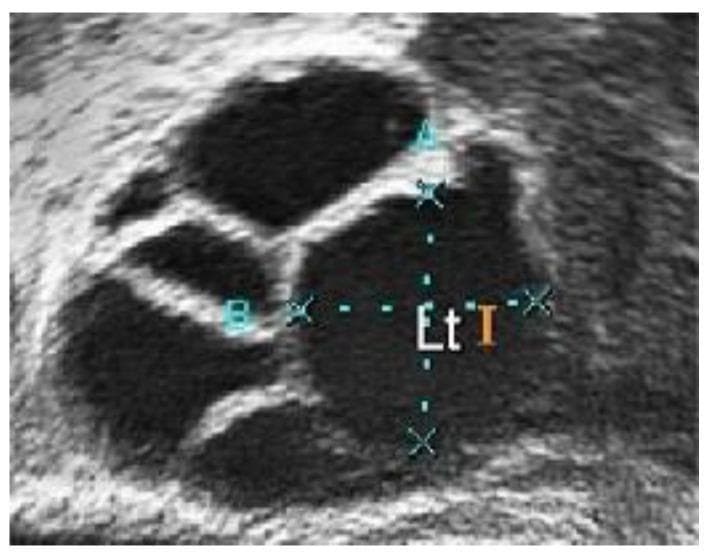 This diagnostic ultrasound image displays a close-up view of an ovary with characteristic features of Polycystic Ovary Syndrome (PCOS). The image shows multiple anechoic (dark), fluid-filled follicles of varying sizes and shapes, primarily circular and oval, distributed within the hyperechoic (bright) ovarian stroma. The largest follicle in the center-right is marked with calipers and annotations ('A', 'B', 'Et I') indicating manual measurement of its dimensions. The follicles exhibit well-defined borders against the surrounding light-pixel tissue, which has a grainy texture due to inherent speckle noise. Clinically, the presence of these numerous developing follicles is a primary diagnostic marker for polycystic morphology. This image is used in medical education to demonstrate the visualization of follicular accumulation and the process of diagnostic measurement during gynecological sonography.