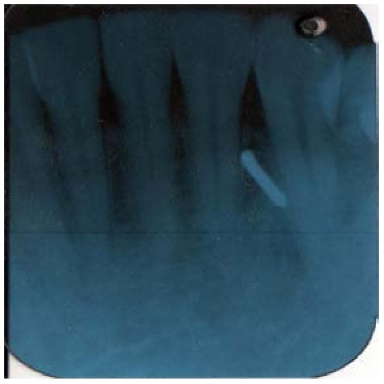 This diagnostic image is a periapical radiograph of the mandibular anterior region, displaying the lower incisors and their supporting structures. The film utilizes a blue-tone processing filter. The anatomical focus is on the dental crowns, roots, and surrounding alveolar bone. A significant clinical finding is a highly radiopaque, cylindrical foreign body located in the soft tissue near the apex of the mandibular left lateral incisor/canine region. This object, consistent with a broken dental bur, is oriented diagonally. The radiograph demonstrates clear delineation of the periodontal ligament spaces and the dense cortical nature of the foreign object relative to the surrounding trabecular bone and soft tissue. This image is used in dentistry to illustrate the detection of iatrogenic foreign bodies and the importance of radiographic follow-up when instruments fail during clinical procedures.