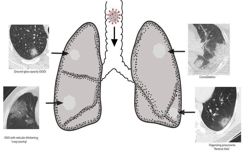 An educational anatomical diagram and comparison chart illustrating the radiological manifestations of COVID-19 lung injury. The central element is a diagram of the respiratory system, showing a SARS-CoV-2 viral particle entering the trachea, leading to bilateral lung involvement. Surrounding the diagram are four labeled chest CT scan segments demonstrating specific patterns: 1) Ground-glass opacity (GGO), appearing as hazy, increased lung attenuation that does not obscure underlying vessels; 2) Consolidation, showing dense, homogenous opacification with obscuration of bronchovascular structures; 3) GGO with reticular thickening, also known as the 'crazy-paving' pattern, characterized by thickened interlobular septa superimposed on a GGO background; and 4) Organizing pneumonia with a 'reverse halo' (atoll) sign, featuring a central area of ground-glass opacity surrounded by a ring of denser consolidation. The diagram highlights the typical peripheral and multi-lobar distribution of these findings, common in viral pneumonia cases requiring diagnostic imaging classification.