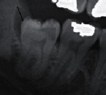 This diagnostic image is a periapical radiograph of the mandibular molar region, specifically focusing on an impacted third molar. The central tooth exhibits a mesioangular impaction, with its crown positioned below the occlusal plane of the adjacent second molar, which features a radiopaque dental restoration. A prominent, well-defined radiolucency is visible surrounding the crown of the impacted third molar. This pericoronal radiolucency is particularly widened on the distal aspect, as indicated by a black arrow. The radiolucent area suggests a pathological lesion such as a dentigerous cyst or enlarged dental follicle, especially as it appears to exceed 3 mm in width. The surrounding trabecular bone density and the roots of the impacted tooth are visible, though the apical morphology is less distinct due to the impaction depth. This image is used in oral and maxillofacial radiology to teach the identification of pericoronal pathology and the classification of impacted teeth using Winters or Pell and Gregory systems.