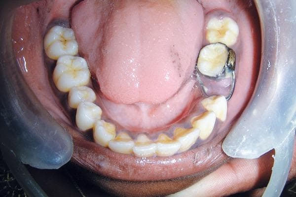 This intraoral clinical photograph provides an occlusal view of the mandibular dental arch in a pediatric patient. The primary focus is a fixed orthodontic appliance—specifically a metallic band and loop space maintainer—situated on the lower left quadrant. The band is cemented to the mandibular first molar, with the wire loop extending mesially to contact the distal surface of the mandibular first premolar, thereby preserving the space left by the premature loss of the second primary molar. The mandibular teeth exhibit mixed dentition with mild extrinsic staining and plaque accumulation along the gingival margins. The tongue is visible in the background, showing normal anatomy with some focal pigmented macules on the dorsal surface. This image serves as a clinical example of space management in pediatric dentistry following the extraction of primary teeth to prevent mesial drifting of permanent molars and subsequent malocclusion.