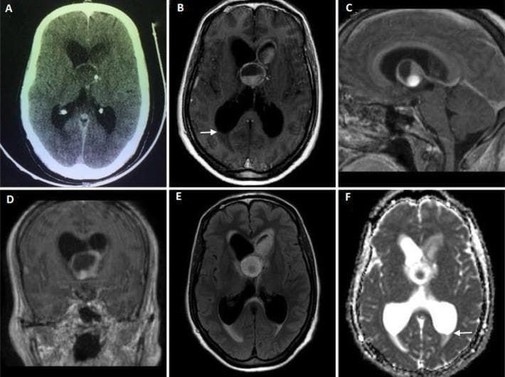A multi-modal neuroimaging compilation (CT and MRI) illustrating a complex intraventricular lesion. Image A (axial contrast-enhanced CT) shows an isodense mass in the third ventricle with focal calcification and peripheral rim enhancement, causing obstructive hydrocephalus of the lateral ventricles. Images B, C, and D provide axial, sagittal, and coronal T1-weighted post-contrast MR sequences, revealing a bilobate cystic lesion involving the third ventricle and extending into the left frontal horn. This lesion demonstrates a distinctive fluid-fluid level and mild peripheral rim enhancement. Image E (FLAIR) highlights heterogeneous internal signal intensity with both hyperintense and hypointense components. Image F (ADC map) demonstrates restricted diffusion in the inferior portion of the lesion and shows dependent debris forming fluid-fluid levels within the occipital horns (white arrows), suggesting intraventricular rupture of an abscess or complex cyst. These findings are clinically relevant for differentiating between intraventricular cystic neoplasms, such as colloid cysts or craniopharyngiomas, and infectious processes like tuberculous brain abscesses.