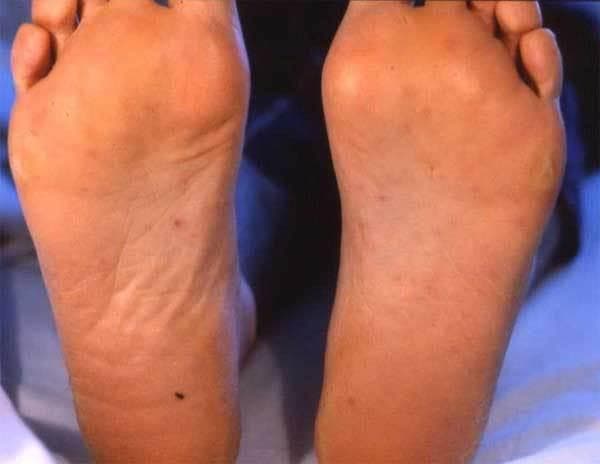 This clinical photograph displays the plantar surfaces of both feet of a 45-year-old patient, exhibiting a disseminated maculopapular rash. The lesions are characterized as non-confluent, reddish-brown macules and small papules distributed bilaterally across the soles. The rash is particularly prominent in the midfoot and heel regions. Notably, the skin integrity remains intact without evidence of ulceration, vesicles, or bullae, although some darker petechial-like spots are visible. This visual presentation is a characteristic dermatologic manifestation of rickettsial diseases, such as Mediterranean spotted fever (caused by Rickettsia conorii or R. massiliae), where involvement of the palms and soles is a key diagnostic sign. The image serves as an educational reference for infectious disease identification, specifically highlighting the distribution and morphology of cutaneous signs in tick-borne spotted fevers.