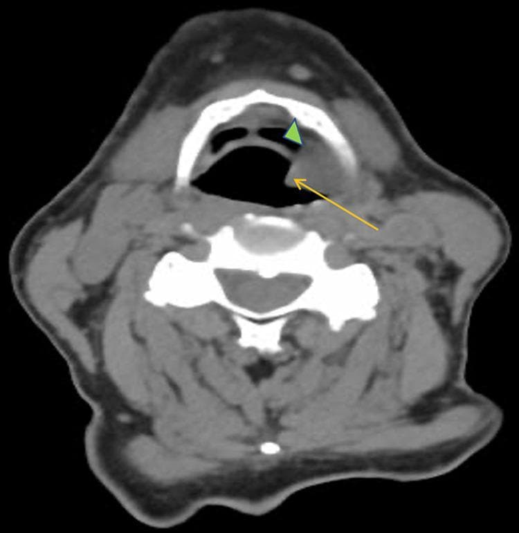 This diagnostic image is an axial contrast-enhanced computed tomography (CT) scan of the neck at the level of the supraglottic larynx. The image demonstrates a prominent, hyperdense soft tissue mass (indicated by a yellow arrow) originating from the left piriform sinus and vallecula (indicated by a green arrowhead). The mass exhibits significant local mass effect, causing partial occlusion and distortion of the laryngeal airway. Anatomical landmarks visible include the hyoid bone anteriorly, the cervical vertebra posteriorly, and the surrounding neck musculature and vasculature. The visual findings are consistent with an invasive neoplastic process, specifically squamous cell carcinoma (SCC) of the larynx. The image provides critical clinical visualization of tumor staging and airway compromise, highlighting the primary site of origin and its relationship to the paraglottic and pre-epiglottic spaces.