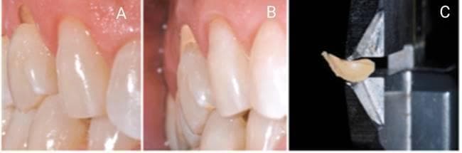 This composite dental image illustrates the identification and quantification of Non-Carious Cervical Lesions (NCCLs). Panel A shows an intraoral clinical photograph of maxillary teeth with visible wear at the cervical margin, appearing as V-shaped or saucer-shaped defects at the cementoenamel junction. Panel B demonstrates the clinical application of an addition silicone (polyvinyl siloxane) molding material into the cervical lesion to create a physical cast of the lost tooth structure. Panel C displays the resulting polymerized elastomeric cast being measured with a digital caliper to determine the precise depth of the lesion. This process is used in restorative dentistry to categorize NCCL severity, assess remaining dentin thickness (RDT), and plan appropriate interventions for tooth wear or hypersensitivity. The educational focus is on the diagnostic methodology for measuring hard tissue loss in the absence of dental caries.