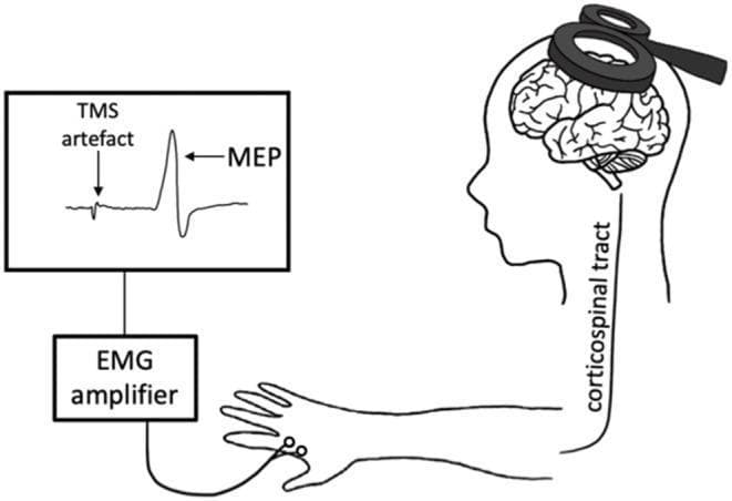 This medical schematic illustrates the physiological pathway of Transcranial Magnetic Stimulation (TMS). The diagram depicts a figure-of-eight TMS coil placed over the scalp, targeting the primary motor cortex (M1). It visualizes the induction of an electric field that depolarizes cortical neurons, initiating a descending volley along the corticospinal tract, which is labeled as a pathway extending from the brain to the upper limb. Surface electrodes placed on a target muscle in the hand capture the resulting motor activity, which is transmitted to an EMG amplifier. The output is displayed on a monitor as an electromyography (EMG) waveform. Key features of the waveform are annotated, including the initial 'TMS artefact' (representing the stimulator's electrical pulse) and the subsequent 'MEP' (Motor Evoked Potential), which demonstrates a biphasic deflection corresponding to the muscle's response. This illustration is intended for educational use in neurology and neurophysiology to explain non-invasive cortical excitability testing.