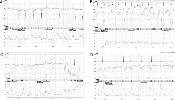 This diagnostic image displays four panels (A-D) of Cardiotocography (CTG) tracings, used in obstetrics to monitor fetal well-being during labor. Each panel consists of two primary waveforms: the upper tracing represents the Fetal Heart Rate (FHR) in beats per minute (bpm), and the lower tracing (TOCO) indicates uterine contraction activity. Panel A illustrates late decelerations, characterized by a gradual decrease in FHR that starts after the peak of a contraction and returns to baseline after the contraction ends. Panel B demonstrates variable decelerations, showing abrupt, irregular drops in FHR of varying shape and duration, often associated with umbilical cord compression. Panel C shows a prolonged deceleration, where the FHR drop lasts more than 2 minutes but less than 10 minutes. Panel D displays early decelerations, which are symmetrical, shallow decreases in FHR that mirror the timing of uterine contractions, typically representing benign fetal head compression. The tracings include annotation arrows and grid lines for temporal and heart rate quantification, serving as a critical tool for identifying fetal hypoxia or distress.