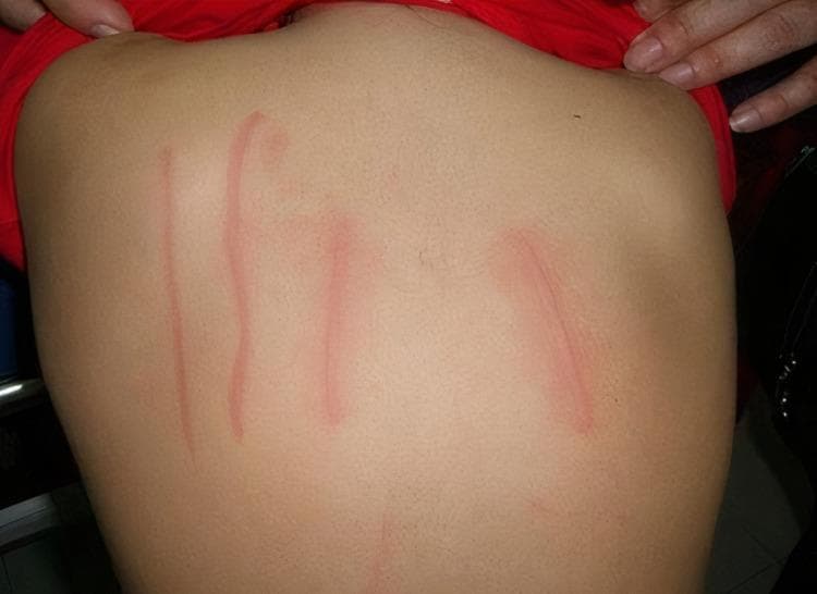Clinical photograph of a patient's back demonstrating symptomatic dermographism, a form of physical urticaria. The image shows several erythematous, linear wheals (skin writing) arranged vertically across the mid-to-lower back. These lesions are characterized by raised, edematous, pink-to-reddish tracks that follow the path of mechanical friction or pressure applied to the skin. The surrounding skin appears normal, without generalized rash or inflammation, highlighting the localized hypersensitivity reaction. This visual serves as a classic diagnostic example of inducible urticaria, often assessed using a calibrated dermographometer to determine the pressure threshold required to elicit a wheal-and-flare response. The presentation is highly relevant for dermatology and allergy/immunology education, specifically for distinguishing between spontaneous and inducible urticarial conditions.