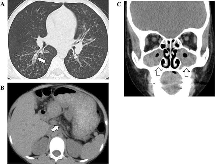 This composite of computerized tomography (CT) images illustrates multi-organ manifestations of cystic fibrosis. Image A (Axial Chest CT) shows significant pulmonary pathology, including bilateral thickened bronchial walls and bronchiectasis (white arrow), with underlying lung hyperinflation indicative of chronic obstructive airway disease. Image B (Axial Abdominal CT) reveals an atrophic pancreas characterized by fatty infiltration (white arrow), a hallmark of exocrine pancreatic insufficiency. Image C (Coronal Facial CT) demonstrates paranasal sinus involvement with bilateral opacification and distinct gas-fluid levels (white arrows), accompanied by internal gas bubbles suggesting acute-on-chronic sinusitis. Together, these diagnostic images provide a comprehensive clinical overview of the respiratory, gastrointestinal, and ENT manifestations associated with CFTR gene mutations.
