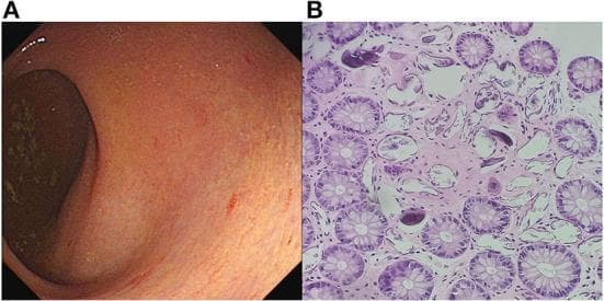 The image consists of two panels illustrating clinical and pathological findings of intestinal schistosomiasis. Panel A is a colonoscopy image showing the enteric mucosa of the rectum. It displays characteristic yellow-white plaque formations and nodules beneath the mucosal surface, accompanied by a blurred or obscured submucosal blood vessel network, indicating a chronic inflammatory response. Panel B is a high-power photomicrograph (200x) of a histological section stained with hematoxylin and eosin (H&E). It reveals numerous transverse and longitudinal sections of colonic crypts and glands. Within the surrounding lamina propria, there are multiple calcified eggs of Schistosoma japonicum, visible as distinct, darkly stained, rounded, or oval bodies. These findings demonstrate the typical pathological manifestation of schistosomiasis in the gastrointestinal tract, where egg deposition triggers localized tissue reactions.