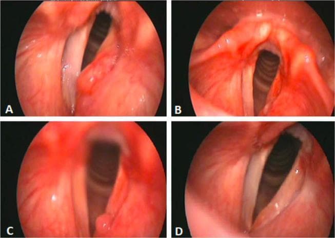 A series of four fiberoptic laryngoscopy images (A, B, C, and D) illustrating the progression and treatment of laryngeal amyloidosis. Image A (pre-operative) shows a prominent, erythematous subepithelial mass on the left false vocal cord extending toward the laryngeal ventricle, causing partial glottic obstruction. Image B (immediate post-operative) demonstrates the glottic area after microlaryngoscopy surgical excision; the mass is absent, though the surgical site shows localized mucosal irregularity and erythema. Image C (4-month follow-up) reveals a small, localized recurrence or focal granulation tissue at the site of the previous excision, accompanied by persistent mucosal hyperemia. Image D (final follow-up) shows a clear glottic opening with significantly improved mucosal health and restoration of regular vocal cord structure. This comparison sequence is an educational resource for Otolaryngology (ENT), highlighting clinical manifestations, post-surgical monitoring, and the healing progression of localized laryngeal lesions.