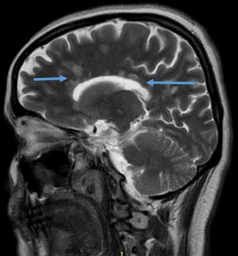 Diagnostic imaging of the human brain featuring a sagittal T2-weighted fluid-attenuated inversion recovery (FLAIR) MRI sequence. The image demonstrates hallmark radiological signs of a demyelinating disease, likely Multiple Sclerosis. Key findings include multiple hyperintense, ovoid-shaped lesions located in the periventricular white matter. Blue arrows specifically highlight 'Dawson's fingers,' which are inflammatory plaques oriented perpendicular to the long axis of the corpus callosum along the path of medullary veins. The FLAIR sequence provides high contrast by suppressing the signal from the cerebrospinal fluid (CSF), which appears dark, making the bright white matter abnormalities more prominent. Visible anatomical landmarks include the cerebral cortex with clearly defined gyri and sulci, the corpus callosum, brainstem, and cerebellum. This image serves as a classic educational example for teaching the neuroimaging criteria used in the diagnosis of central nervous system demyelination.