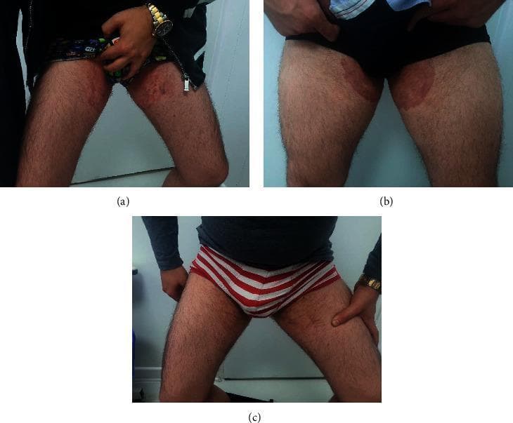 This set of clinical photographs illustrates the progression and treatment of resistant tinea cruris (groin dermatophytosis). Panels (a) and (b) represent the baseline clinical state in two different patients, showing large, well-demarcated, erythematous, and brownish plaques localized to the bilateral groin and upper inner thighs. The lesions exhibit central clearing in some areas but are characterized by active, scaly, and crusted borders, indicative of a persistent fungal infection. Panel (c) provides a comparison chart showing the clinical resolution of the same patients following systemic antifungal therapy with voriconazole. In this follow-up image, the previously visible inflammatory plaques have significantly faded, leaving behind clear skin with a more uniform texture and color, and an absence of active scaling or crusting. This series demonstrates the clinical manifestation of Trichophyton-induced dermatophytosis that was initially resistant to standard terbinafine and fluconazole treatments, and highlights the visual evidence of therapeutic success after second-line antifungal intervention.