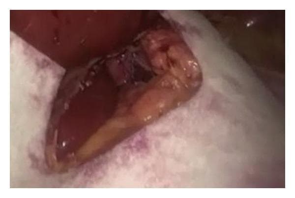 This clinical photograph captures an intraoperative view during a laparoscopic hiatal hernia repair (hiatoplasty). The image shows the application of Gore Bio-A Tissue Reinforcement, a synthetic absorbable mesh, over the diaphragmatic crura. The surgical field includes the exposed muscular pillars of the diaphragm, which have been primarily closed with sutures to reduce the esophageal hiatus. The white, translucent, 'U'-shaped mesh is seen positioned over the crura to provide structural reinforcement to the repair. The material is flexible, conforming to the anatomical contours of the retroesophageal space. Darker areas along the mesh edges indicate fixation points where absorbable sutures or tacks are used to secure the material to the underlying muscle, preventing migration. This procedure is performed to treat large hiatal hernias and gastroesophageal reflux disease (GERD) by strengthening the crural closure and reducing the risk of recurrence while avoiding the complications associated with non-absorbable permanent meshes.