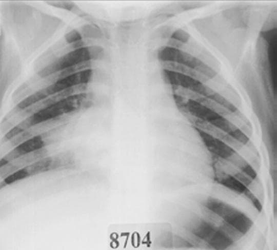 This frontal pediatric chest radiograph displays a diagnostic image of the thorax demonstrating classic features of lobar pneumonia. The primary finding is a large, dense, and relatively homogenous area of increased radiopacity located within the right lower lung field. This consolidation extends from the mid-lung zone down to the right hemidiaphragm, which it partially obscures, indicating an alveolar filling process. Key radiographic features include visible air bronchograms—linear and branching lucencies representing air-filled bronchi outlined by the surrounding consolidated lung parenchyma. The opacity appears non-segmental and occupies a substantial portion of the right lower lobe. The mediastinal structures, including the heart and trachea, appear centrally located without significant deviation. This image serves as a clinical example of bacterial pneumonia, typically associated with pathogens such as Streptococcus pneumoniae, highlighting the consolidation and air bronchogram signs essential for medical student and radiologic technologist education.