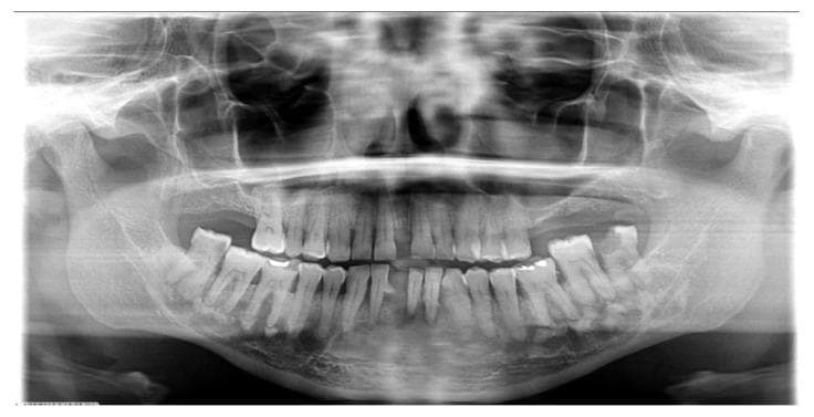 This orthopantomogram (panoramic radiograph) demonstrates a classic case of Florid Cemento-Osseous Dysplasia (FCOD) in a 48-year-old patient. The primary pathology consists of multiple, diffuse, and bilateral mixed radiolucent-radiopaque lesions involving both the right and left quadrants of the mandible. These lesions exhibit a varying 'cotton-wool' appearance with ill-defined borders, consisting of confluent dense sclerotic masses surrounded by thin radiolucent rims. The lesions are primarily located in the periapical and alveolar bone regions of the mandible. Key dental features include the absence of a visible lamina dura in affected areas, while the periodontal ligament spaces remain largely intact. Some teeth show evidence of restorative work and mild periodontal bone loss. The widespread, multifocal distribution across multiple quadrants without significant cortical expansion or tooth displacement is a hallmark of this fibro-osseous condition, common in middle-aged women of African descent. This diagnostic image serves as a high-level educational example for oral and maxillofacial pathology and dental radiology.