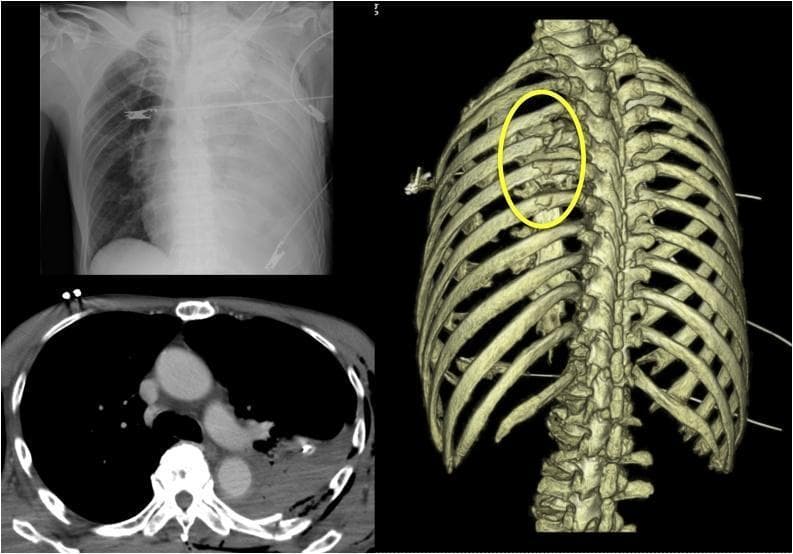 A composite medical diagnostic image presenting a chest radiograph, an axial CT scan, and a 3D reconstructed CT image of the thorax following trauma. The supine anteroposterior (AP) chest X-ray (top left) demonstrates complete opacification of the left hemithorax, suggestive of massive hemothorax or pleural effusion. The axial soft tissue window CT scan (bottom left) confirms a large, high-attenuation pleural collection in the left hemithorax consistent with blood (hemothorax), causing passive compressive atelectasis of the left lung parenchyma. The posterior 3D CT reconstruction (right) highlights severe skeletal trauma, specifically identifying multiple comminuted fractures of the left fourth through seventh ribs, demarcated by a yellow oval. The displaced fracture segments show significant misalignment and sharp edges. This multi-modal presentation illustrates acute thoracic trauma, skeletal injury (multiple rib fractures), and associated secondary complications (massive hemothorax) in a clinical emergency context.