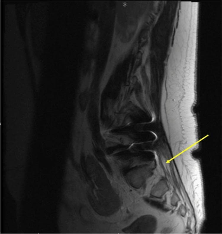 This diagnostic image is a sagittal view of a lumbar spine MRI with gadolinium contrast enhancement. The anatomical region shows the lumbar vertebrae, intervertebral discs, and the spinal canal. Key findings include diffuse pathological enhancement of the cauda equina nerve roots, highlighted by a yellow arrow, which is a classic radiologic sign for inflammatory conditions such as Guillain-Barré Syndrome (GBS) or chronic inflammatory demyelinating polyneuropathy (CIDP). The image also demonstrates multisegmental degenerative changes, characterized by disc space narrowing and endplate irregularities. Signs of prior surgical intervention (postsurgical changes) are visible in the posterior soft tissues and vertebral structures. The cauda equina enhancement stands out against the relatively normal signal intensity of the vertebral bodies, suggesting increased vascularity and breakdown of the blood-nerve barrier. This imaging is clinically significant for the diagnosis of inflammatory demyelinating polyradiculoneuropathies.