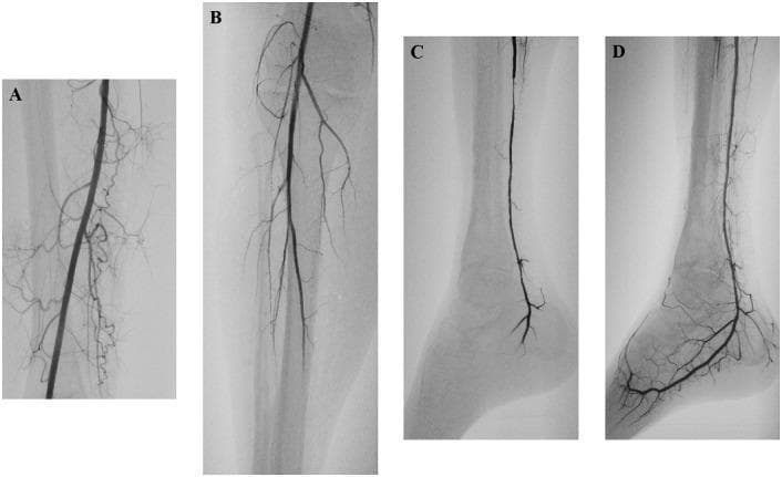 This set of diagnostic angiograms illustrates a case of acute limb ischemia and the subsequent management using embolectomy and intra-arterial thrombolysis. (A) Angiogram of the thigh shows a patent superficial femoral artery with no signs of atherosclerosis. (B) Image of the knee and upper calf shows a patent popliteal artery, but reveals acute distal occlusion of the posterior tibial artery and chronic occlusion of the anterior tibial and peroneal arteries. (C) Follow-up angiogram of the ankle/foot after mechanical embolectomy with a Fogarty catheter shows restored flow in the posterior tibial artery, yet persistent distal occlusion with no contrast filling in the plantar arch. (D) Final angiogram 24 hours after adjunctive intra-arterial administration of recombinant tissue plasminogen activator (rtPA) demonstrates complete restoration of distal perfusion, with excellent filling of both the posterior tibial artery and the plantar arch. This progression highlights the combined efficacy of surgical and pharmacological interventions in treating peripheral arterial embolism and restoring microvascular patency.