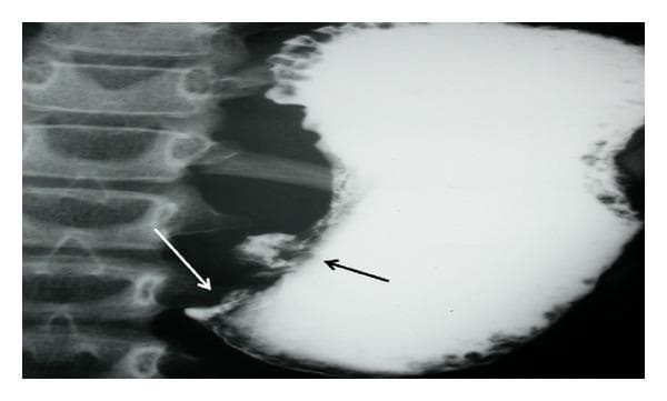 This diagnostic image is an upper gastrointestinal barium meal radiograph (X-ray) focusing on the stomach and pyloric region. The contrast study reveals a significantly distended stomach filled with radiopaque barium. Two key pathological findings are annotated: a black arrow indicates a localized, irregular projection of contrast along the lesser curvature, representing an ulcer crater. A white arrow points to the distal antrum/pylorus, where there is an abrupt, tapered termination of the contrast column with no visible passage into the duodenum, characteristic of a high-grade gastric outlet obstruction. The vertebral column is visible to the left of the gastric shadow. This radiographic appearance is clinically significant for diagnosing mechanical obstruction and mucosal lesions, such as those caused by peptic ulcer disease or gastric malignancy. The image is intended for intermediate to advanced medical learners studying gastrointestinal radiology and surgical pathology.