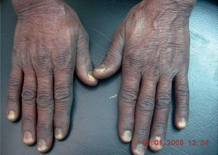 Clinical photograph showing the dorsal aspect of both hands, demonstrating diffuse, uniform cutaneous hyperpigmentation and specific melanonychia. The skin on the hands and fingers exhibits a generalized darkening, particularly accentuated over the knuckles and interphalangeal creases, with a slightly dry, xerotic texture. All ten fingernails show significant hyperpigmentation involving the proximal one-half to two-thirds of the nail plates, presenting as dark brown-to-black transverse bands that start at the cuticle and progress distally. The distal margins of the nails remain relatively spared. This visual presentation is characteristic of drug-induced pigmentation, commonly associated with chemotherapeutic agents such as hydroxyurea. The image serves as an educational reference for identifying adverse dermatological reactions to systemic medications and differentiating them from other causes of generalized hyperpigmentation like Addison's disease or Vitamin B12 deficiency.
