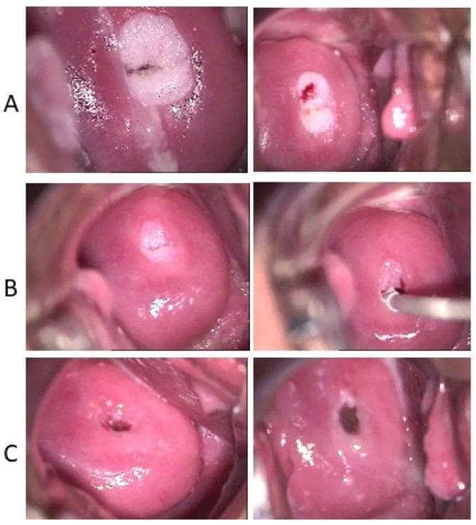 A series of colposcopy images illustrating the therapeutic progression of cervical condyloma acuminata after the application of 3% acetic acid. The clinical timeline is divided into three stages: (A) Baseline visit showing a prominent, raised acetowhite lesion on the ectocervix, consistent with a flat condyloma (low-grade squamous intraepithelial lesion). The right panel of (A) demonstrates the site of a histological punch biopsy. (B) Treatment phase images showing significant regression of the acetowhite area, with the lesion becoming smaller and less defined as pharmacological intervention proceeds. (C) Long-term follow-up at ten months demonstrating restitutio ad integrum, characterized by the complete resolution of the exophytic lesion and return to normal cervical mucosal appearance with a smooth, pink squamous epithelium and no residual acetowhite changes. This timeline serves as a clinical educational tool for monitoring Human Papillomavirus (HPV)-related cervical pathologies and their response to antiviral or topical therapy.