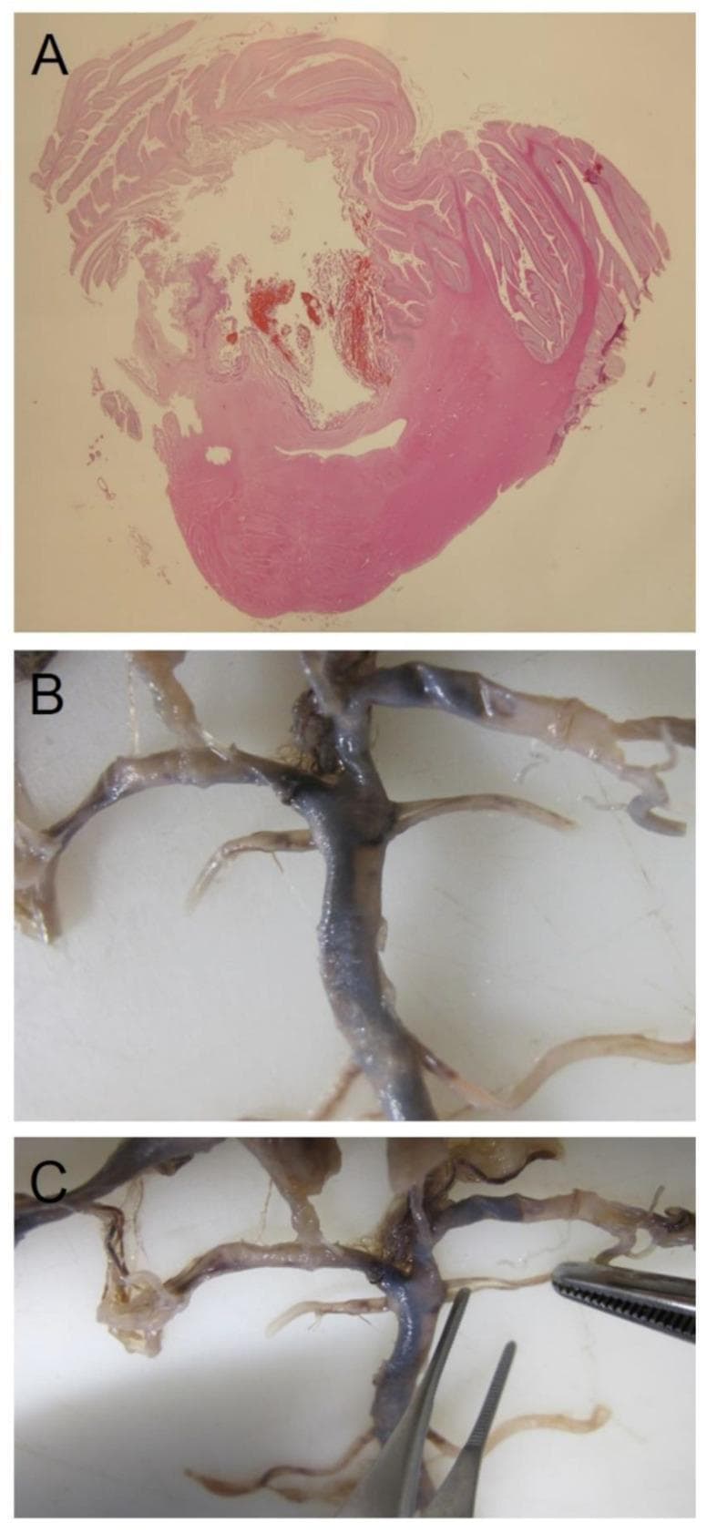This composite educational image illustrates a case of anatomical variation and its pathological consequences in the central nervous system. Panel (A) is a low-magnification microscopic macro-section of human cerebellar tissue. It demonstrates a hemorrhagic infarction localized within the vascular territory of the superior cerebellar artery. The tissue exhibits characteristic folia architecture, with a central area of irregular, dark-red extravasated blood and adjacent tissue pallor indicative of edema and ischemic damage. Panels (B) and (C) are macroscopic clinical photographs of a gross dissection of the cerebral vasculature. They highlight an anatomical variation of the left superior cerebellar artery characterized by a 'double origin' from the basilar artery. The vessels appear as pale, tubular structures against a neutral background, with panel (C) using surgical instruments (forceps and needle) to demonstrate the specific branching pattern and point of origin. This material serves as a teaching aid for forensic pathology and neuroanatomy, emphasizing the clinical significance of 'individual anatomy' and the correlation between vascular anomalies and ischemic or hemorrhagic stroke.