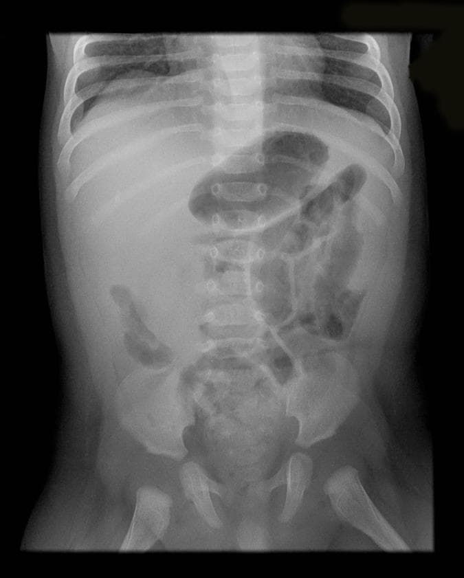 This diagnostic image is an anteroposterior (AP) supine abdominal radiograph of a pediatric patient. The X-ray demonstrates classic signs of a bowel obstruction, likely secondary to intussusception. Visible features include several dilated, gas-filled proximal small bowel loops concentrated in the upper and central abdomen. There is a notable paucity of distal bowel gas in the lower abdominal quadrants and pelvis. In the right hypochondrium, a subtle soft tissue mass effect is present, which can represent the intussusceptum. Bony structures including the lower ribcage, spine, iliac wings, and proximal femurs appear normal for the patient's developmental age. This clinical photograph serves as a primary educational example for identifying small bowel obstruction patterns and localizing pathology in pediatric emergency radiology.