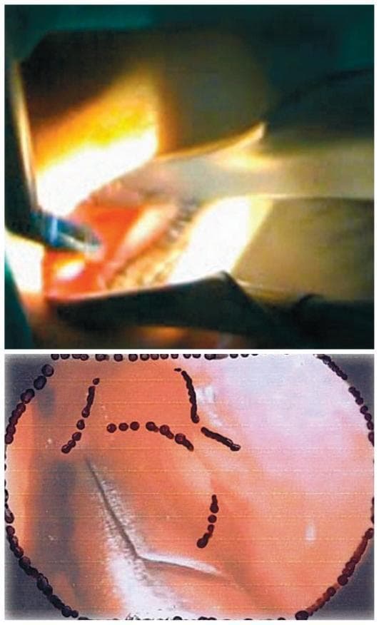 Two-panel clinical photograph and illustration detailing steps of an endonasal dacryocystorhinostomy (DCR). The top panel is a clinical photograph showing an intraoperative view of the nasal cavity during a surgical procedure. A straight Blakesley forceps is seen with its jaws firmly grasping a mucosal flap on the lateral nasal wall, anterior to the middle turbinate. The operative field is illuminated by a transillumination light probe, highlighting the reddish-pink, vascularized soft tissue and the metallic surgical instrument. The bottom panel provides a schematic representation or endoscopically-guided visualization framed within a dark circular border. This image shows the surgical target area on the nasal mucosa, marked with distinct dark red dotted lines and linear patterns. These markings serve as anatomical guides for the intended mucosal incision or bone removal sites, such as the lacrimal fossa. The background shows characteristic mucosal folds and reflective surfaces typical of the intranasal environment. This visual content illustrates the precise tissue manipulation and preoperative mapping required for successful lacrimal sac exposure in ophthalmic surgery.