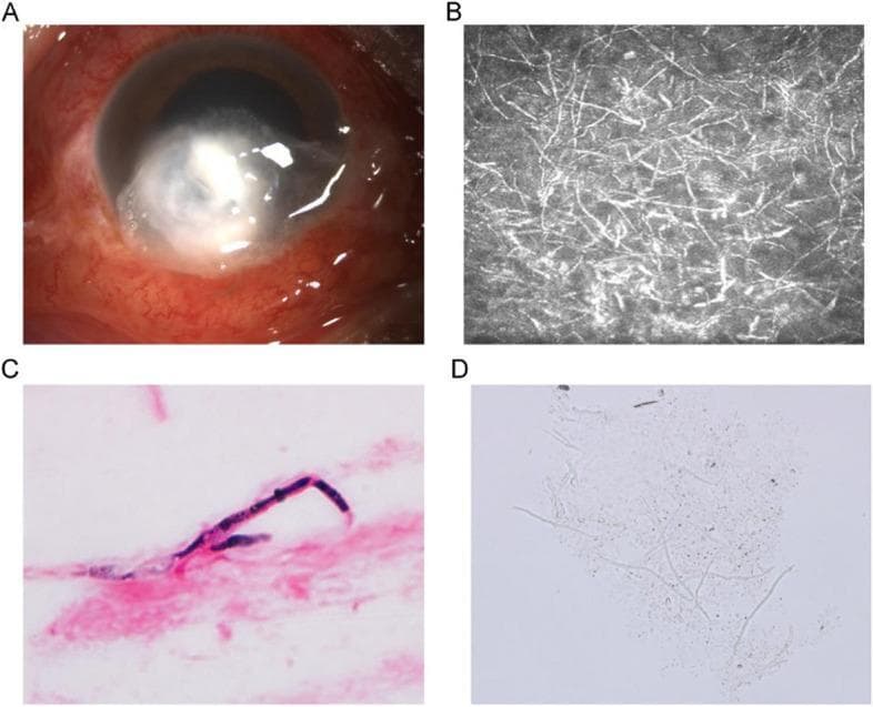This composite image illustrates the clinical and diagnostic features of fungal keratitis. Panel A is a clinical photograph of the eye showing a significant central and peripheral corneal ulcer characterized by feathery, infiltrating margins, elevated lesions, a dry-appearing surface, and surrounding conjunctival hyperemia. Panel B presents an in vivo confocal microscopy image, revealing a dense network of highly reflective, branching filamentous structures consistent with fungal hyphae within the corneal stroma. Panel C shows a Gram-stained microscopic view of corneal scrapings, where a deep purple, septate fungal hypha is clearly visualized against a pink cellular background. Panel D displays a potassium hydroxide (KOH) wet mount of corneal scrapings under light microscopy, demonstrating translucent, slender, branching fungal hyphae. This series of images demonstrates the progression from clinical presentation to definitive microbiological diagnosis using various imaging and staining modalities, highlighting the morphological characteristics of mycotic corneal infections.