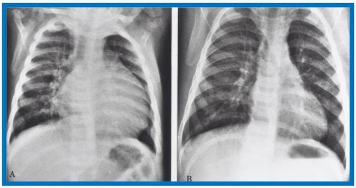 This Comparison Chart displays two side-by-side antero-posterior (AP) chest X-rays of an infant, demonstrating the radiographic progression of congestive heart failure management. Panel A (pre-therapy) shows significant cardiomegaly with an increased cardiothoracic ratio and prominence of the left heart border. The lung fields exhibit increased perihilar opacities and blurred vascular markings, characteristic of pulmonary venous congestion. Panel B (post-therapy, following hydralazine administration) demonstrates a remarkable improvement in the clinical state. There is a visible reduction in the heart silhouette size, suggesting a decrease in moderate cardiomegaly. The lungs appear significantly clearer with increased radiolucency and sharper definition of vascular markings and rib outlines, indicating the resolution of pulmonary venous congestion. These diagnostic images are essential for teaching pediatric cardiology concepts, specifically the radiographic manifestations of left ventricular dysfunction and the effectiveness of vasodilator therapy in improving cardiac output and reducing pulmonary backup in infants.